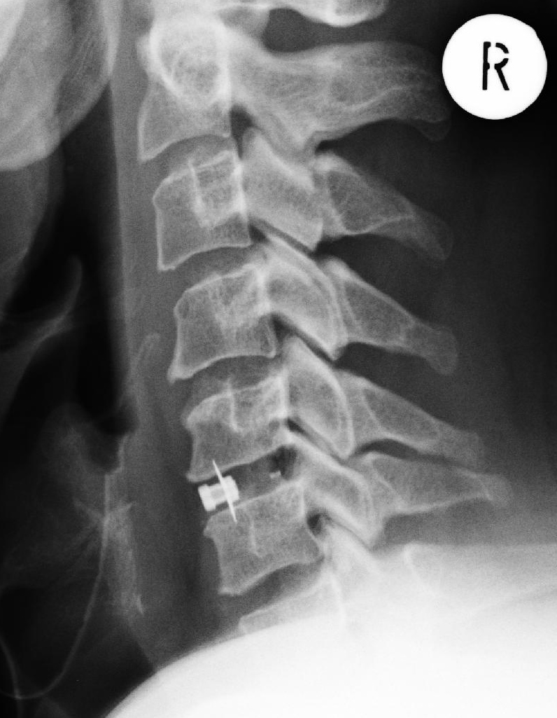 Wie sieht die Therapie einer Spinalkanalstenose in der Halswirbelsäule aus?