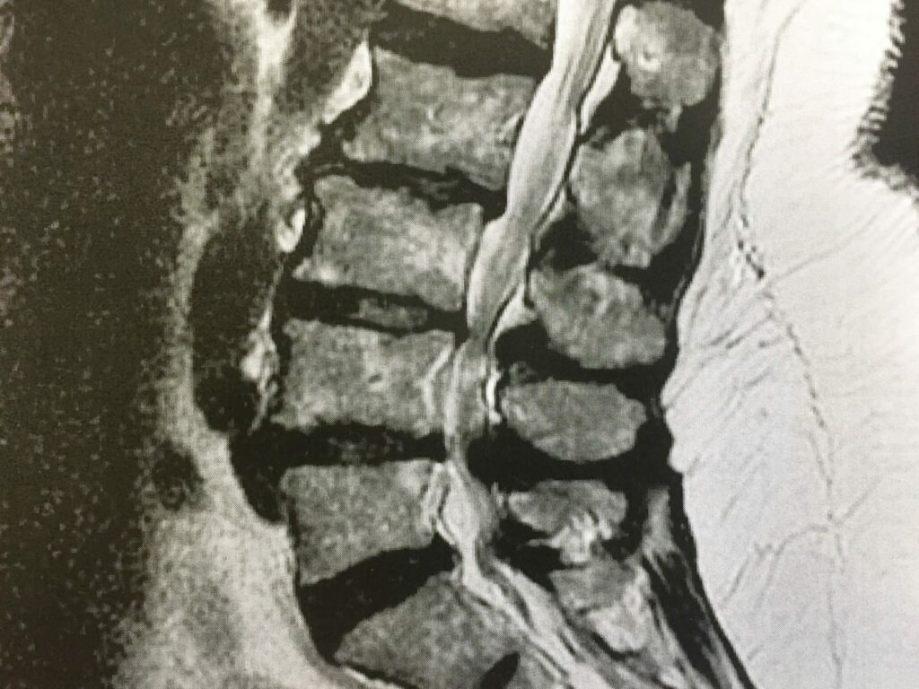 Wie sieht die Therapie einer Spinalkanalstenose in der Lendenwirbelsäule aus?