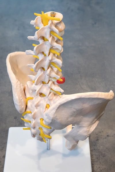 Wie sieht die Therapie eines Bandscheibenvorfalls in der Lendenwirbelsäule aus?